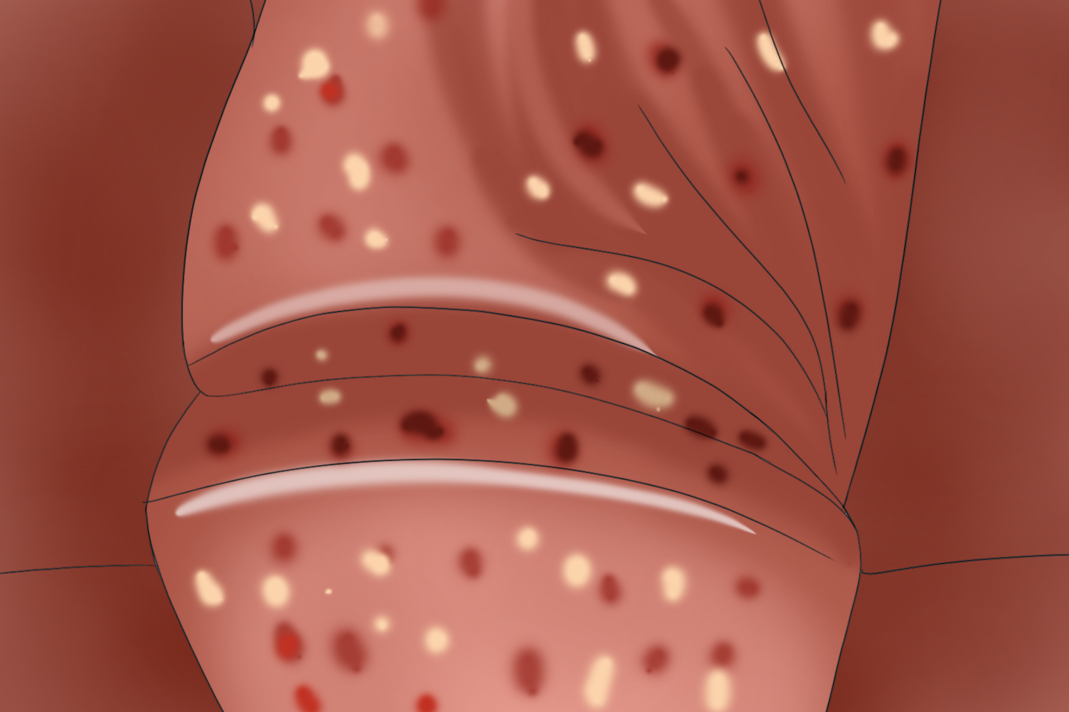 生殖器疱疹龟头皮疹图
