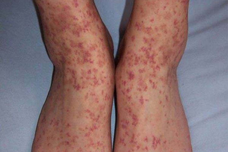 过敏性紫癜脚背及脚踝有紫斑图