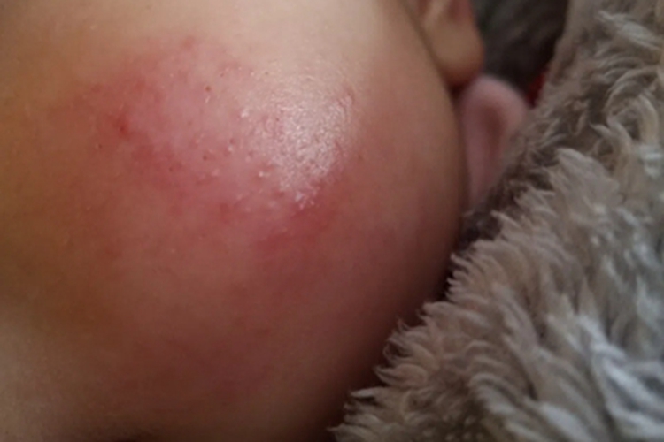 新生儿红斑丘疹图 新生儿红斑丘疹图