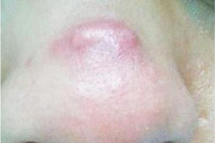 高雄性激素性痤疮鼻部结节图