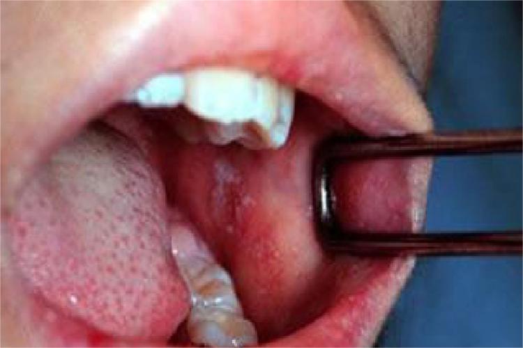 口腔麻疹黏膜斑图