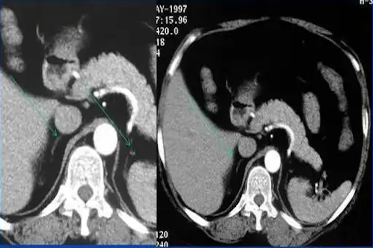 肾上腺变小CT表现图