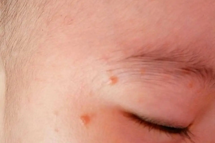 脸上扁平疣初期图