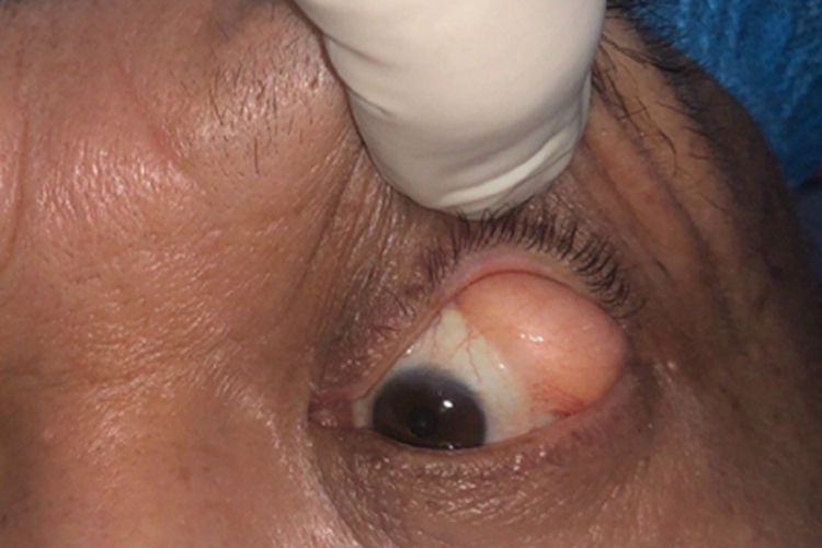 角膜皮样瘤症状图 角膜皮样瘤症状图