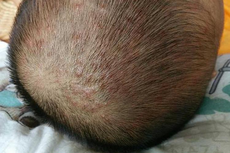 头部毛囊炎红色丘疹图