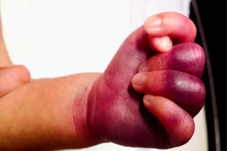 暴发性紫癜手部症状图