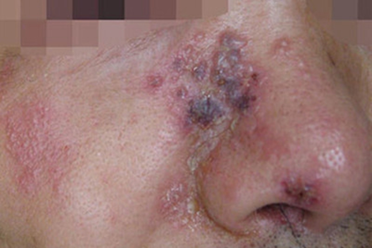 带状疱疹鼻部症状图