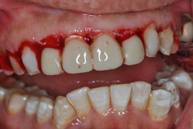 急性坏死性龈口炎牙龈出血图