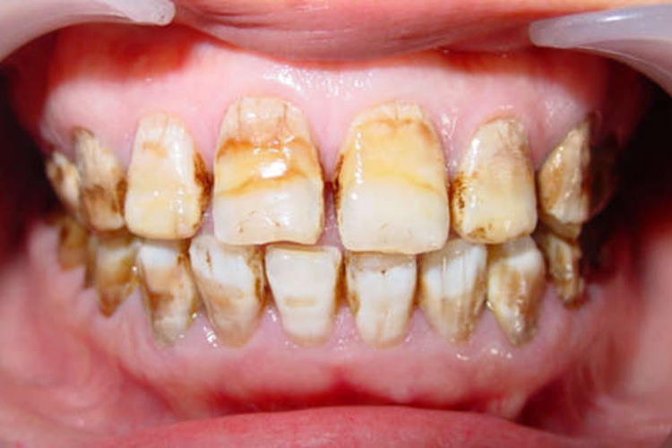 门牙黄斑图 门牙黄斑图
