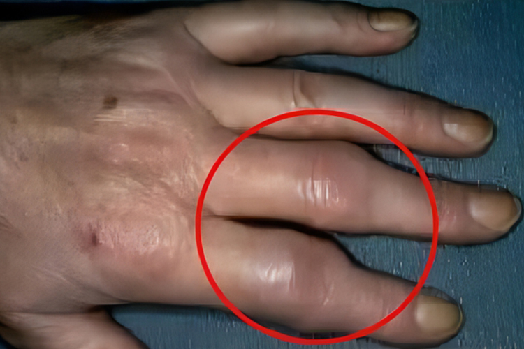 手指关节结核症状图