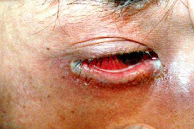 淋菌性结膜炎图