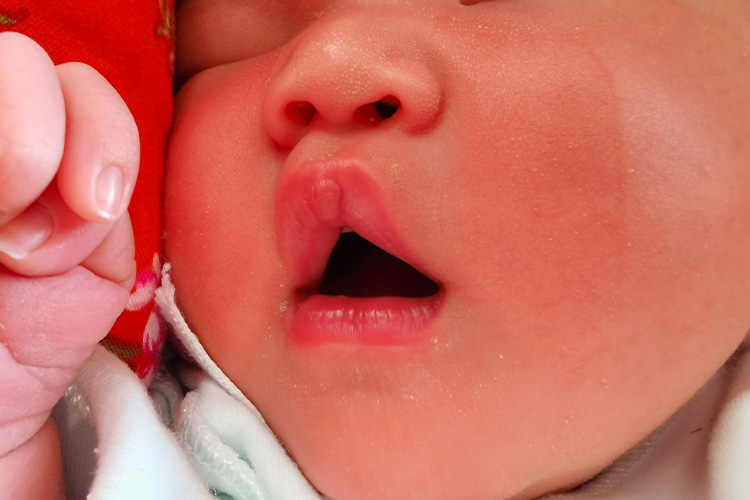 婴儿晶形粟粒疹图 婴儿晶形粟粒疹图