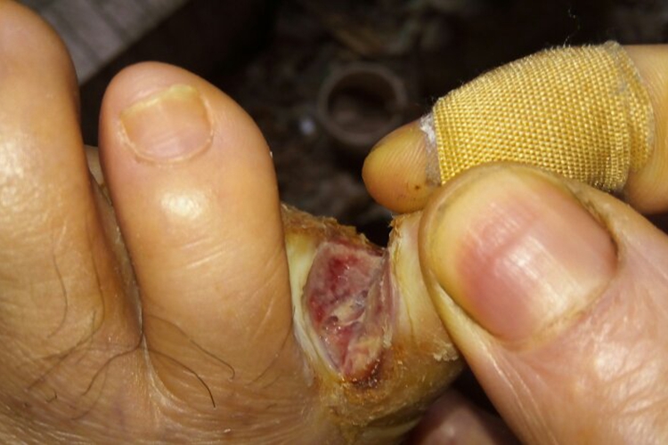 男性尖锐湿疣脚趾症状图 男性尖锐湿疣脚趾症状图