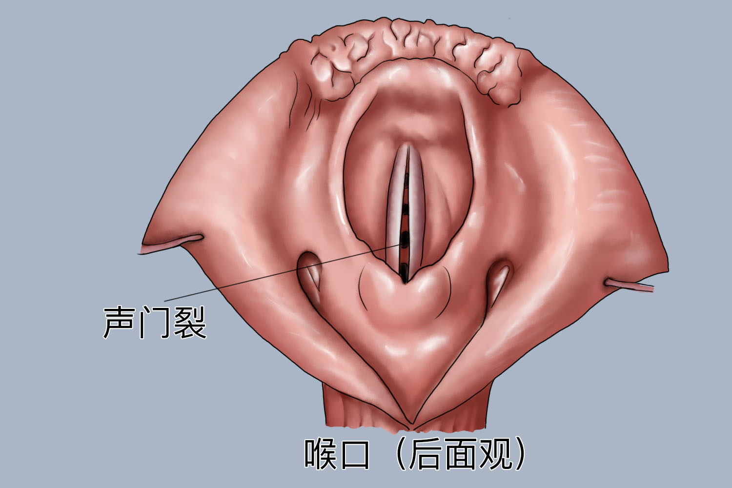 声门裂位置图 声门裂位置图