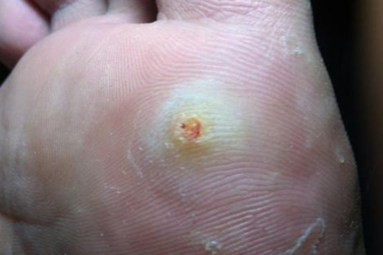 脚底长鸡眼图
