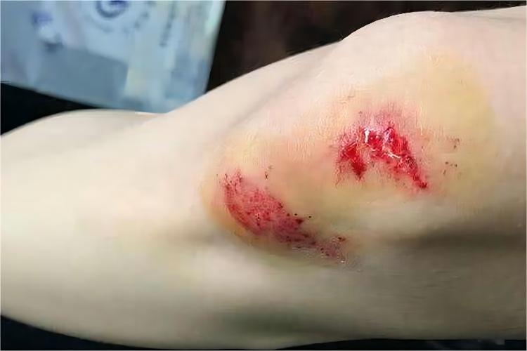 膝盖摔伤后开放性伤口图