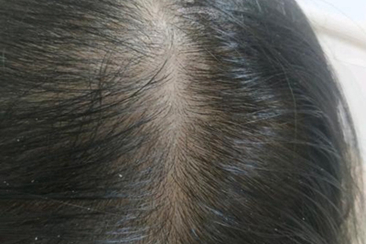 少毛症头顶头发稀少图 少毛症头顶头发稀少图