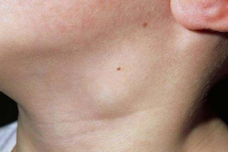 淋巴结肿大图 淋巴结肿大图