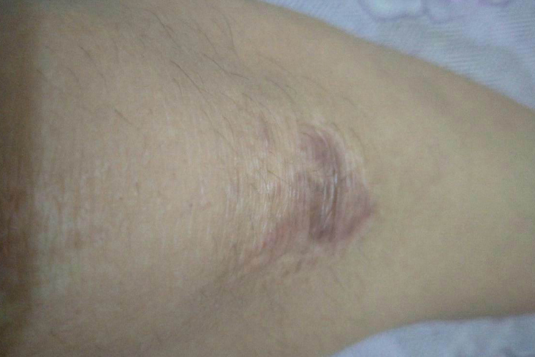膝盖萎缩性瘢痕图 膝盖萎缩性瘢痕图