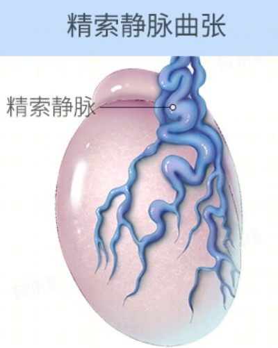 静脉精索曲张是怎么回事-有来医生
