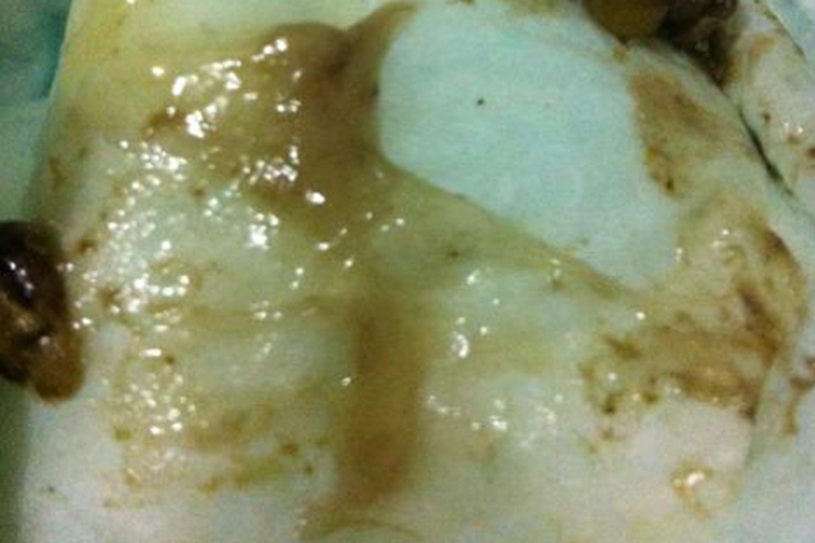 婴儿喂养不当大便排出黏液图