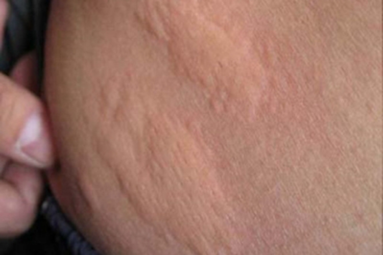 昆虫性皮炎腹部风团图