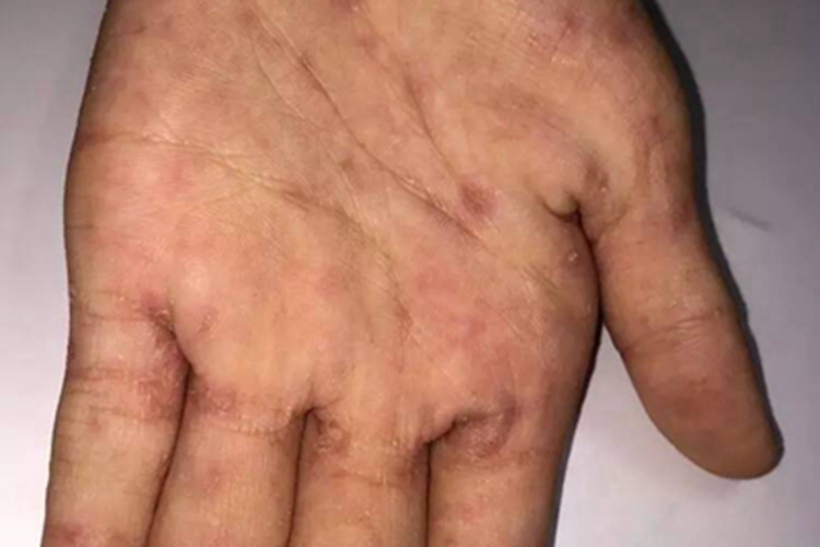 疥疮手上长红斑结痂图 疥疮手上长红斑结痂图