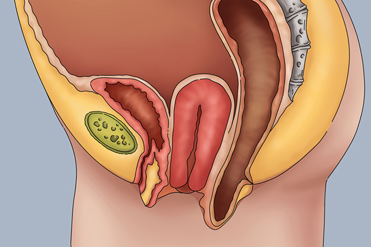 重度Ⅰ度子宫脱垂图