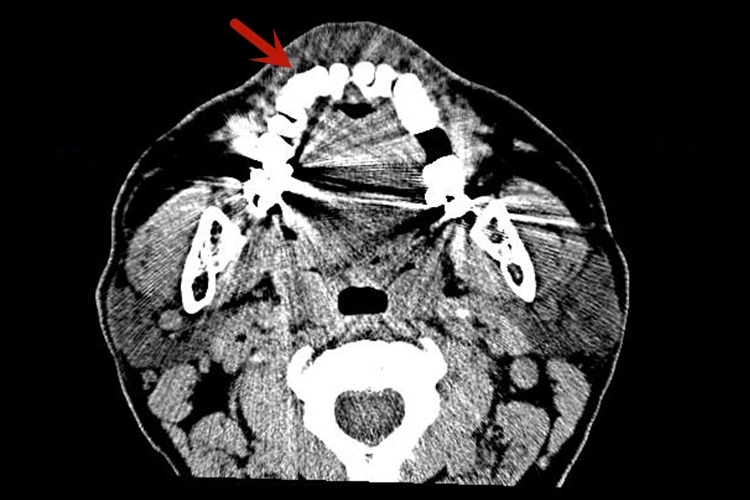 正常颌面部CT牙齿图 正常颌面部CT牙齿图