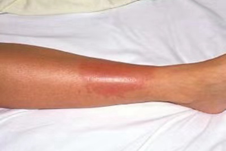 急性期硬化性脂膜炎小腿症状图 急性期硬化性脂膜炎小腿症状图