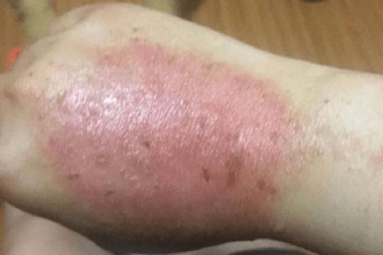 手部湿疹手背有一大块红斑图