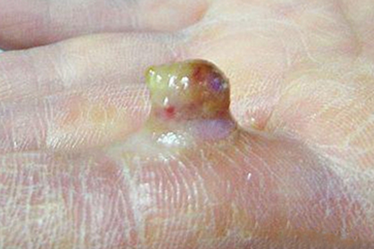 铍肉芽肿手指化脓图