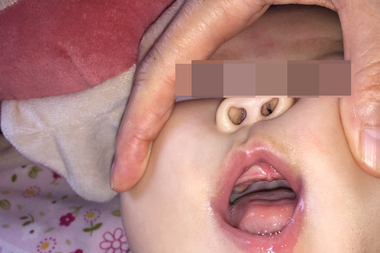 2个月婴儿口腔上颚标准图