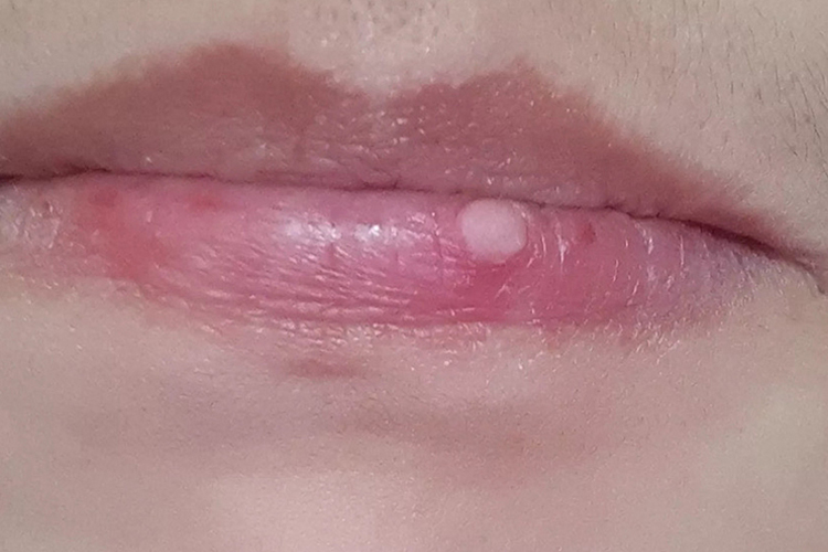 嘴唇扁平疣图