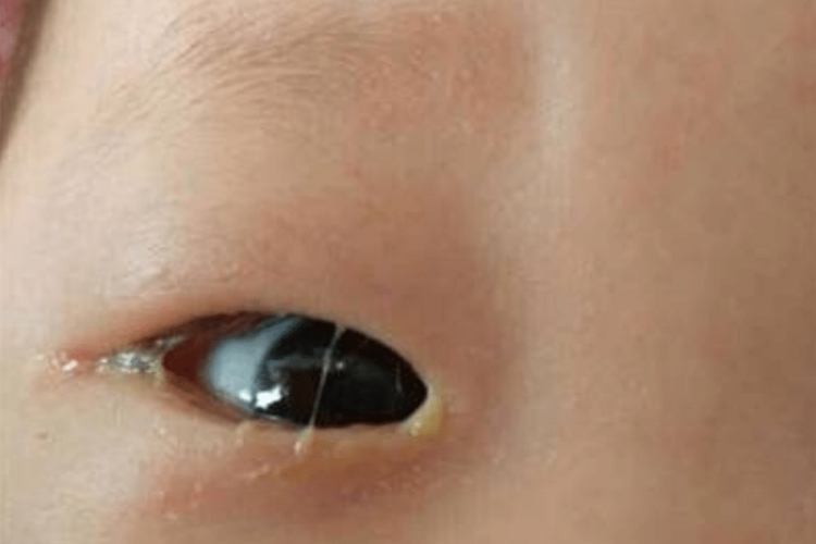 宝宝眼睛分泌物增多图