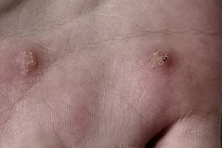 寻常疣手部硬疙瘩图 寻常疣手部硬疙瘩图