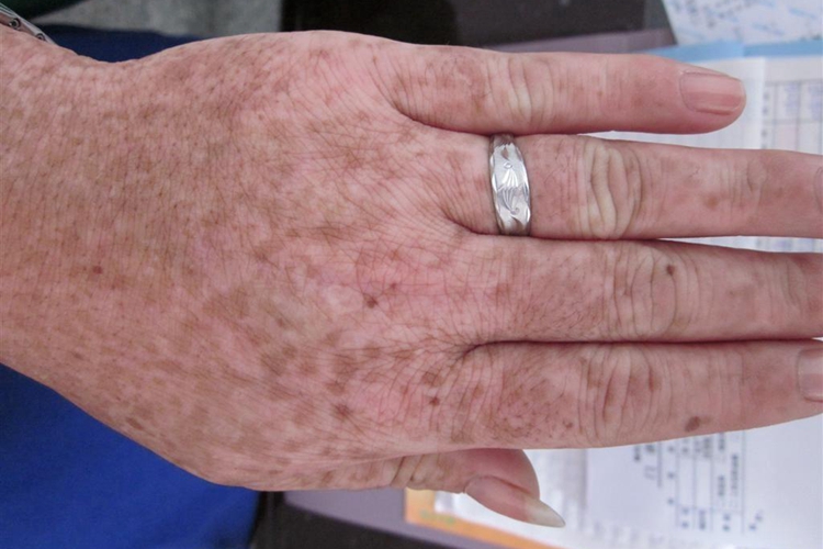 土肥对称性肢端色素沉着症黑点图