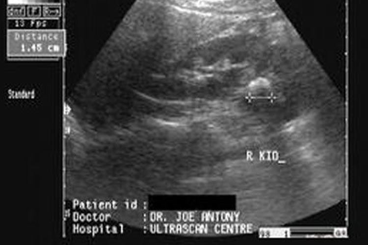 肾结石的B超检查图
