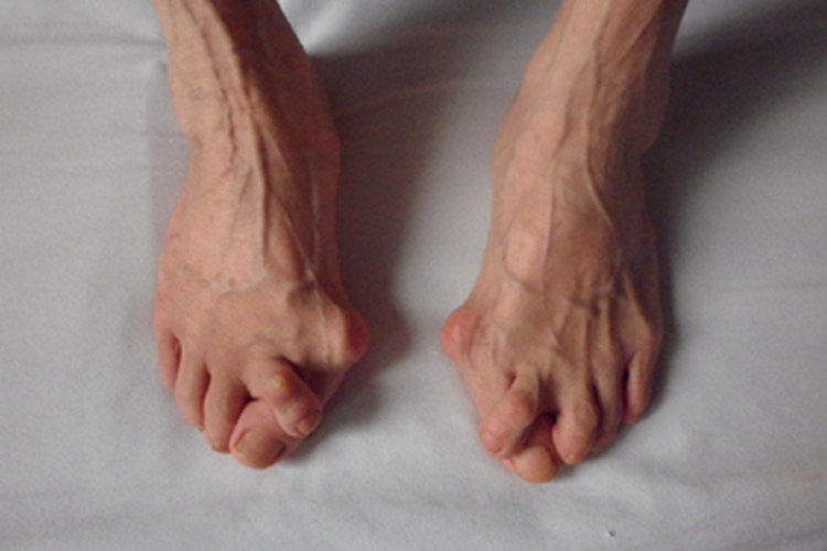 拇趾滑囊炎脚趾畸形图