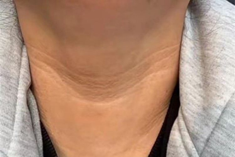 假性黑棘皮病初期图