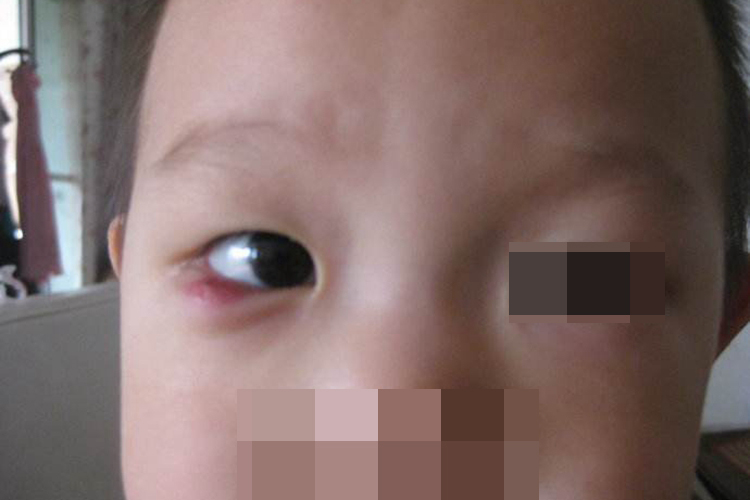 睑腺板囊肿眼尾发炎红肿图 睑腺板囊肿眼尾发炎红肿图