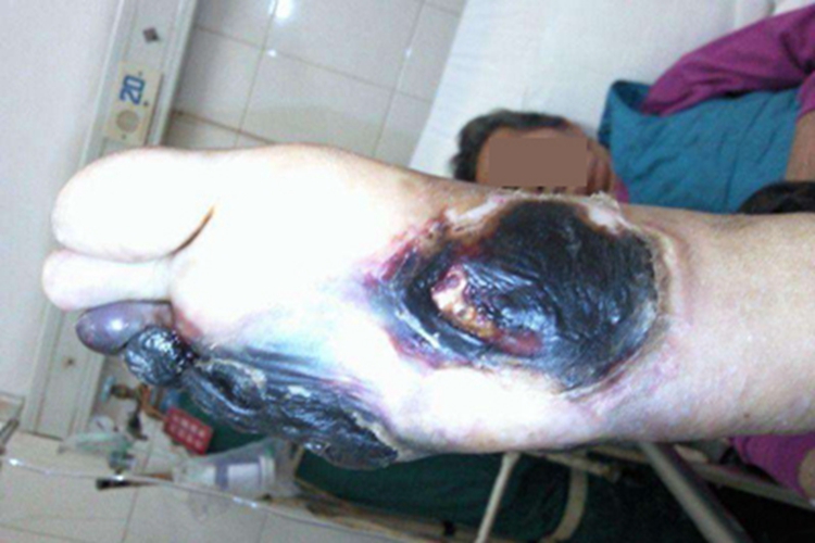 干性坏疽皮肤发黑图 干性坏疽皮肤发黑图