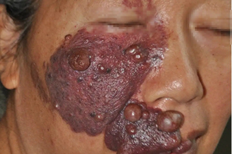 静脉畸形面部疙瘩图 静脉畸形面部疙瘩图