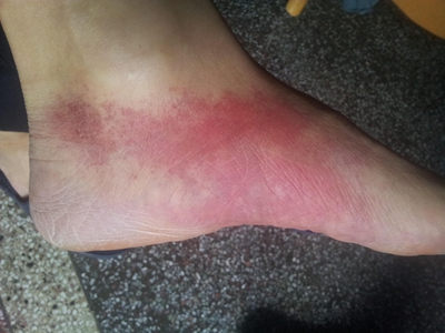 一氧化碳中毒患者可表现为丹毒样红斑,发生于脚部时,呈不规则形,边界