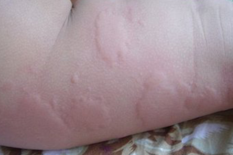 宝宝自发性荨麻疹皮肤风团图