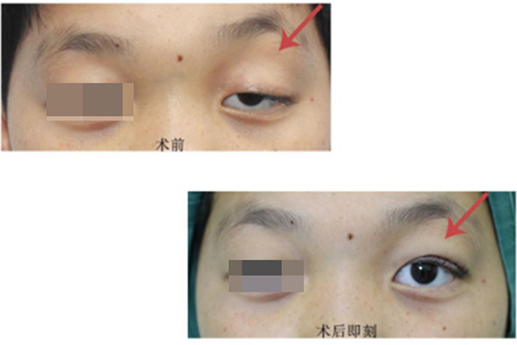 上睑下垂手术前后图