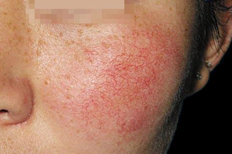 星状红血丝图 星状红血丝图