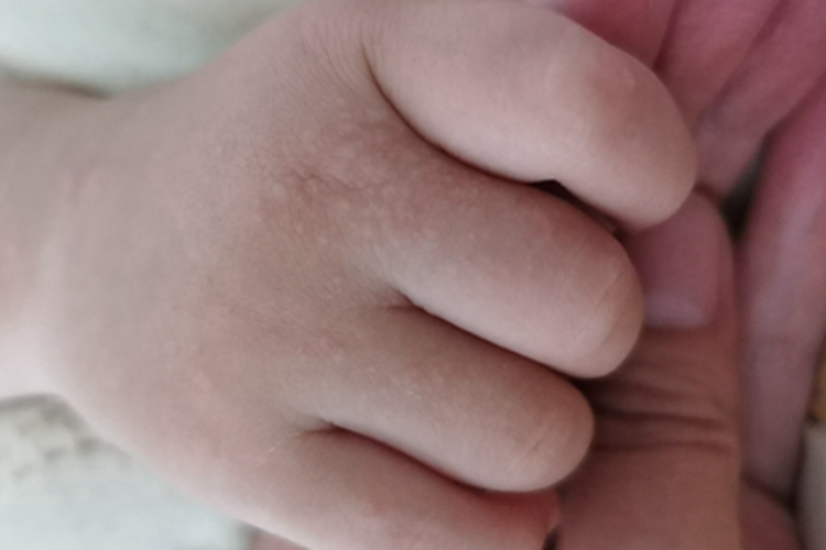 汗疱疹手背有密集小丘疹图