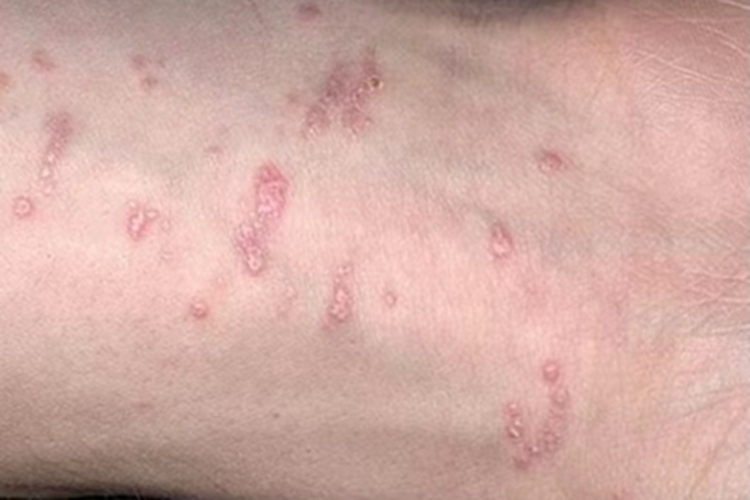 扁平苔藓手腕红斑疙瘩图