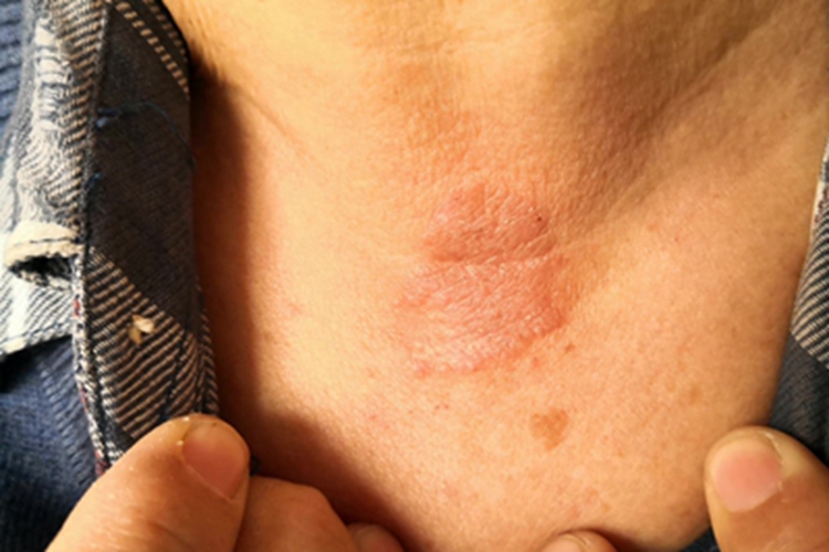 变应性接触性皮炎胸部脱屑图 变应性接触性皮炎胸部脱屑图